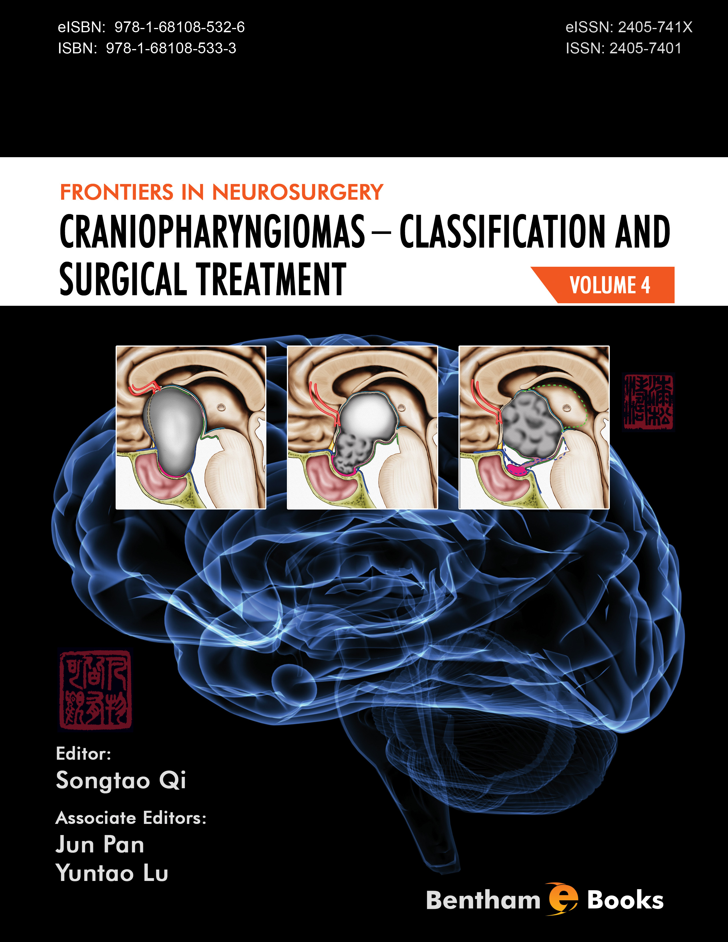Craniopharyngiomas − Classification and Surgical Treatment