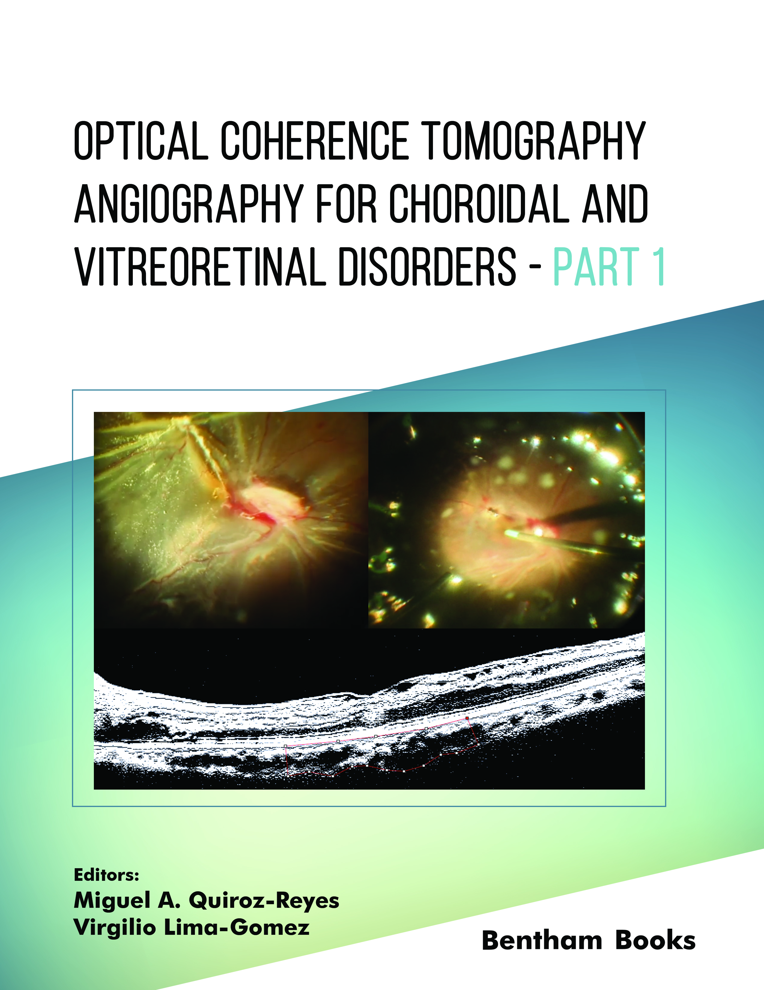 Optical Coherence Tomography Angiography for Choroidal and Vitreoretinal Disorders – Part 1